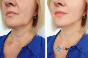 Double chin before and after Hi-Fu treatment 4 Book your double chin treatment Kirkby in Ashfield today! We are here to help!