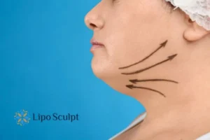 Double chin before and after Hi-Fu treatment 3 Boost your confidence with a Double chin treatment Kirkby in Ashfield