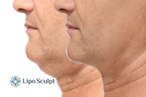 Double chin before and after Hi-Fu treatment 2 Double chin treatment Kirkby in Ashfield from Lipo Sculpt - feel more confident today!