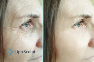 How to Fight Aging Symptoms 2 Do you want to Fight Aging Symptoms Kirkby in Ashfield? Contact Lipo Sculpt today!