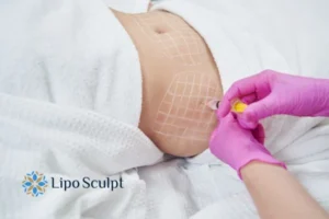 Are The Results From Aqualyx Permanent? 1 Do you want to know how long Aqualyx Kirkby in Ashfield results last?