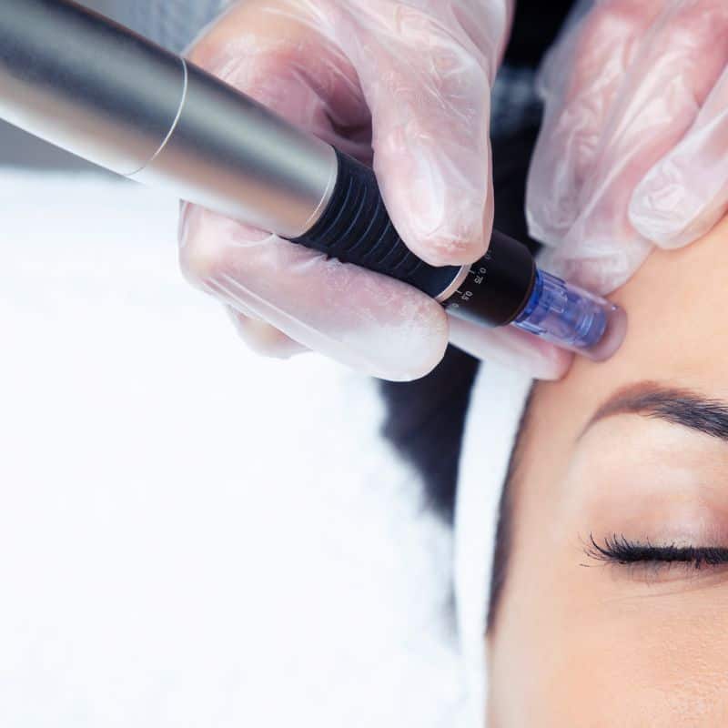 Morpheus8 treatment Kirkby in Ashfield from Lipo Sculpt - Book in today!